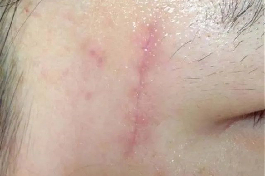 浅表性疤痕 第1张