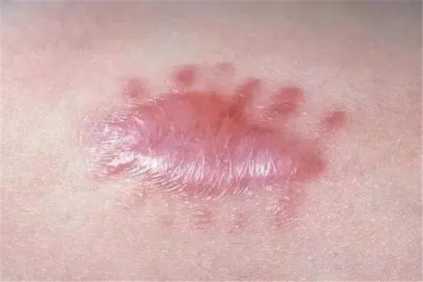 挛缩性疤痕 第4张