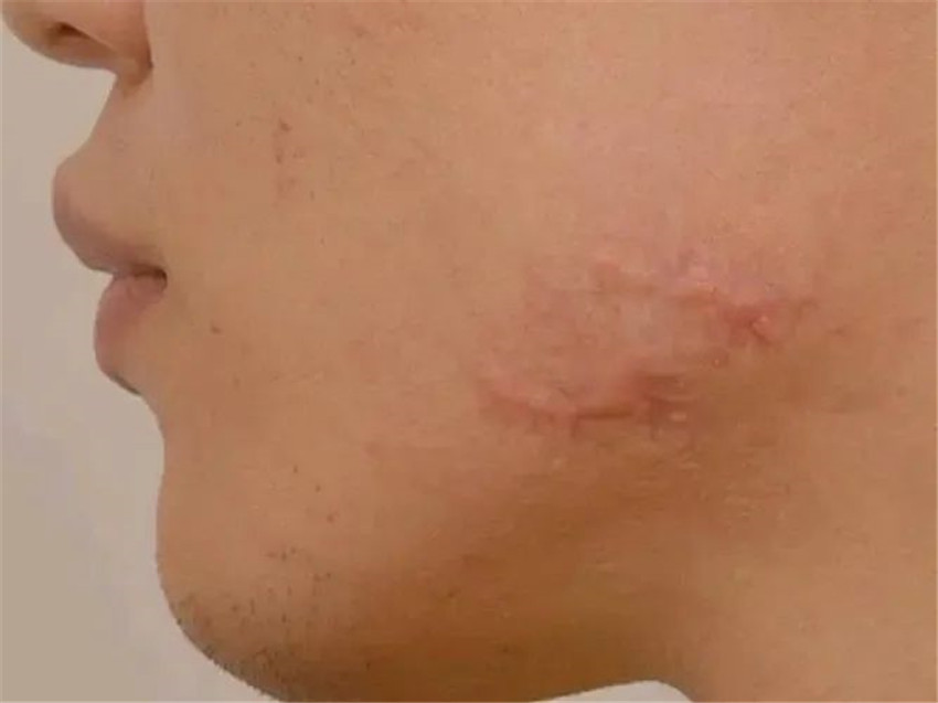 疤痕增生 第5张