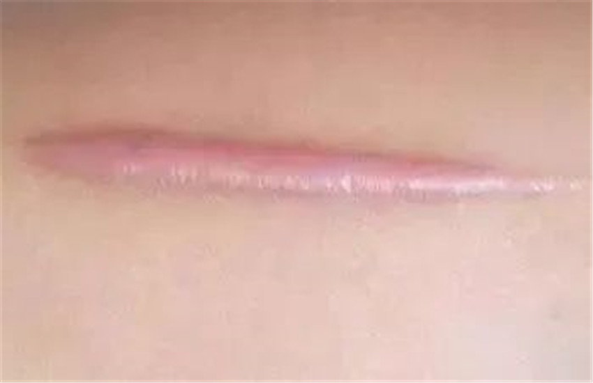 疤痕疙瘩 第6张