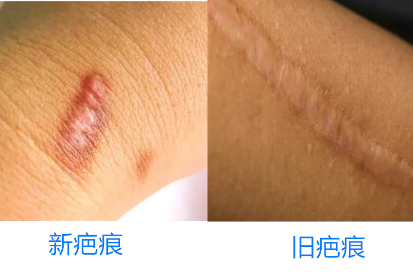 旧疤痕还能修复吗？新疤比旧疤更容易修复吗？的图片